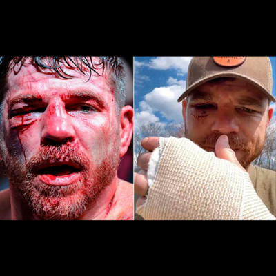 Jim Miller Reveals Injuries Suffered at UFC 300, Including 23 Stitches to Close Gruesome Cut.