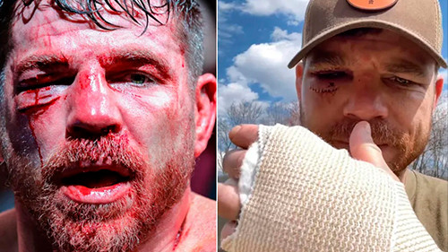 Jim Miller Reveals Injuries Suffered at UFC 300, Including 23 Stitches to Close Gruesome Cut.